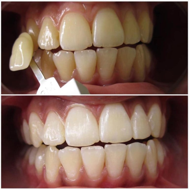 Zwei Nahaufnahmen eines Gebisses vor und nach Zahnbleaching. Oben: Gelbliche Zahnfarbe mit Farbmuster-Vergleich. Unten: Aufgehellte, gleichmäßige Zahnfarbe.