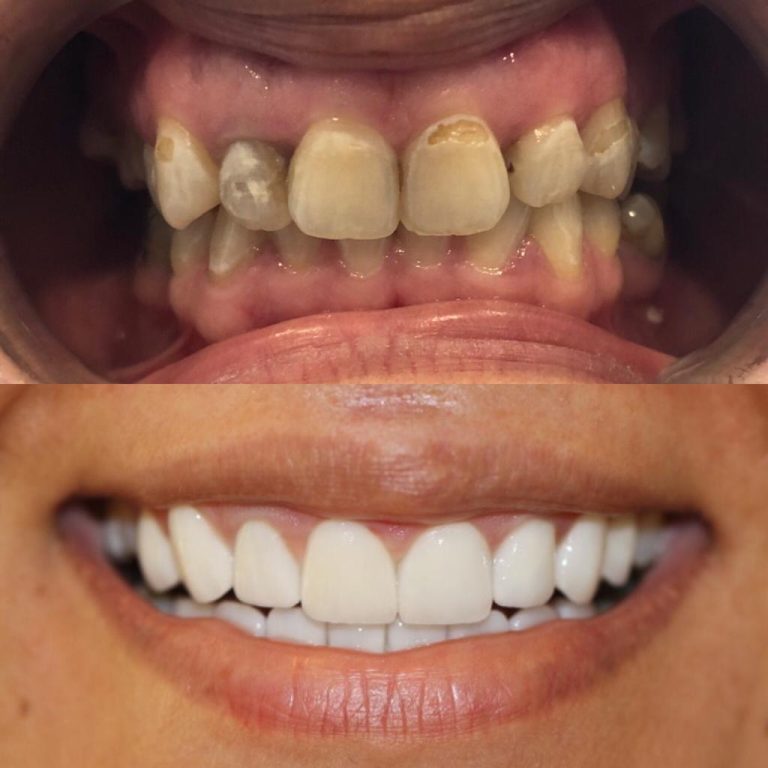 Zwei Bilder einer Person vor und nach Veneers in der Türkei. Oben: beschädigte, verfärbte Zähne mit Zahndefekten. Unten: vollständige, gleichmäßige, weiße Zahnreihe.