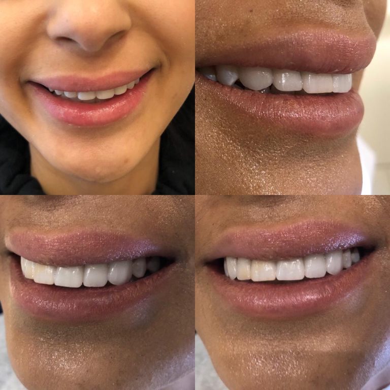 Veneer-Behandlung in der Türkei