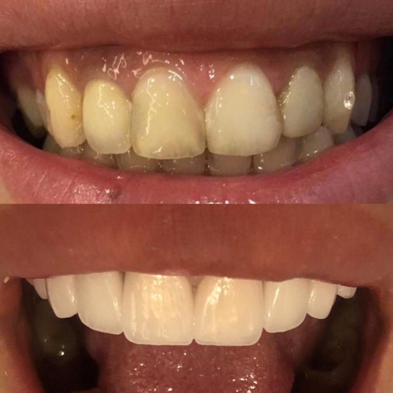 Vorher-nachher-Vergleich einer ästhetischen Veneer-Behandlung in der Türkei mit deutlicher Aufhellung und Formkorrektur der Frontzähne.