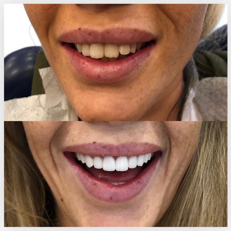 Veneer-Makeover in der Türkei mit DSG Schönheitsreisen – natürliche Zahnform optimiert, Farbe deutlich aufgehellt.