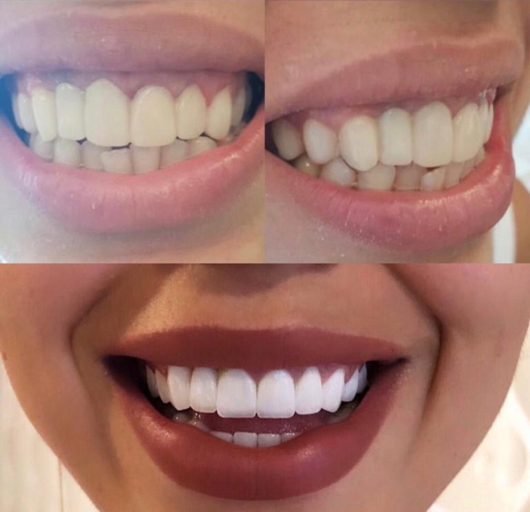 Optimierung eines unnatürlich wirkenden Zahnersatzes durch ästhetische Veneers in der Türkei – Behandlung organisiert von DSG Schönheitsreisen.