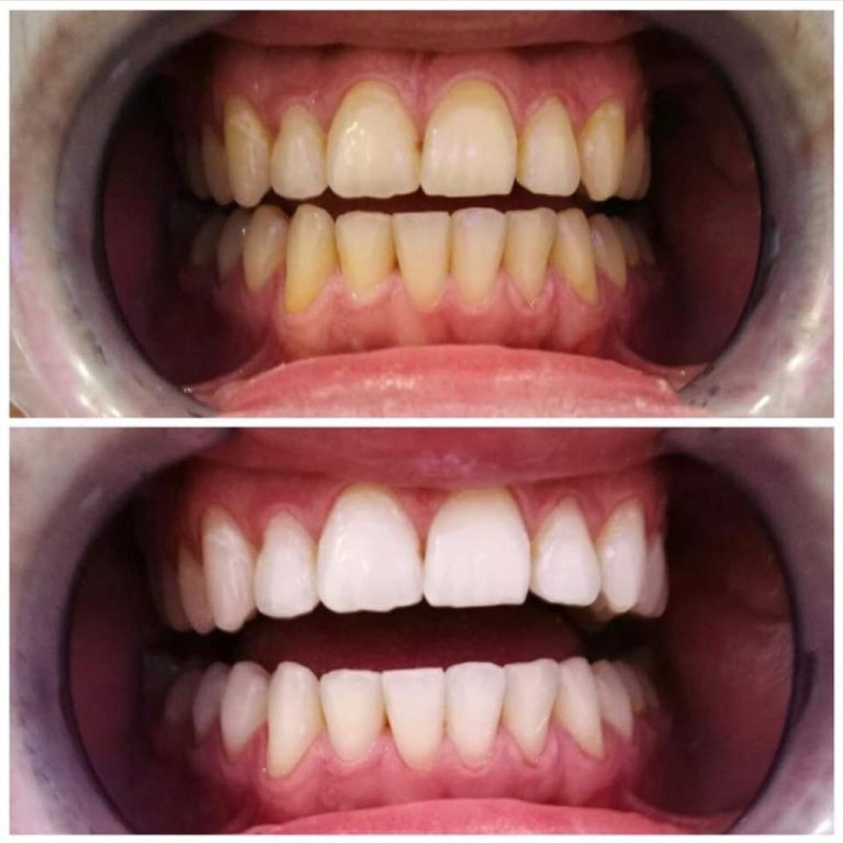Professionelles Zahnbleaching in der Türkei – Zahnverfärbungen deutlich aufgehellt durch ästhetische Behandlung mit DSG Schönheitsreisen.