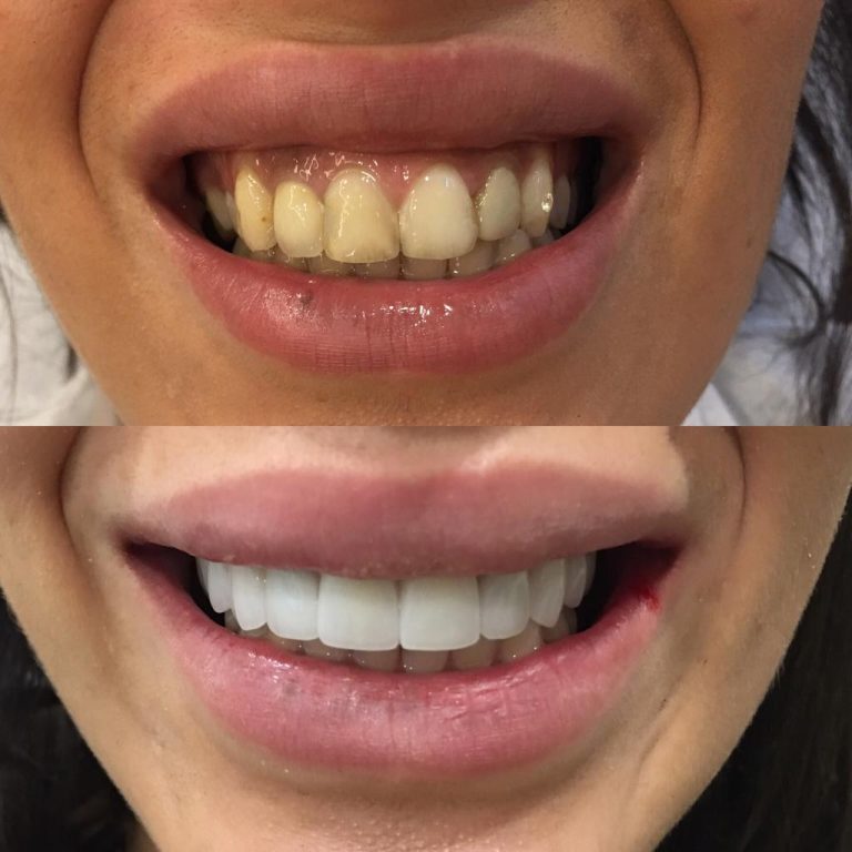 Zwei Bilder einer Frau vor und nach Veneers in der Türkei. Oben: verfärbte, unregelmäßige Zähne. Unten: helle, gleichmäßige Zahnreihe.