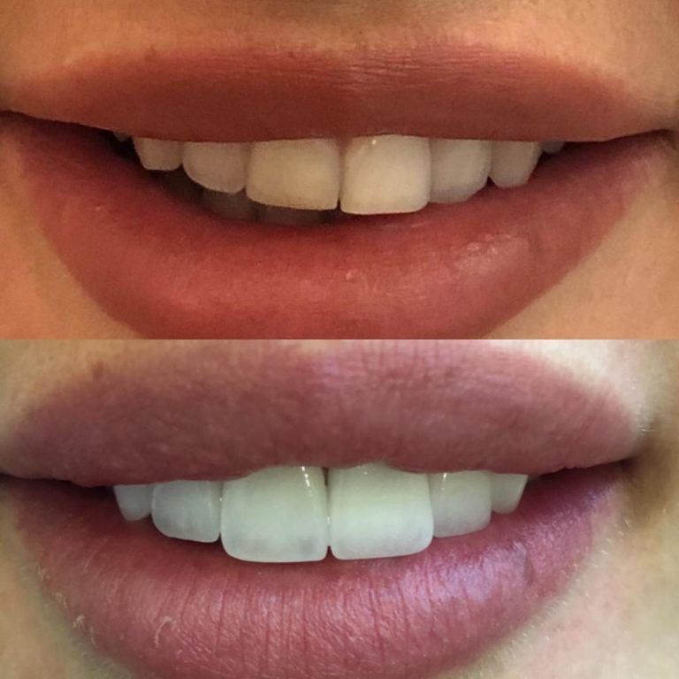 Vorher-Nachher Ergebnisse einer Veneers-Behandlung in der Türkei