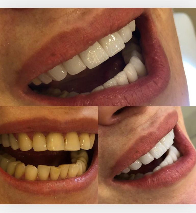 Veneers Vorher Nacher im All Inclusive Paket von DSG Schönheitsreisen Türkei
