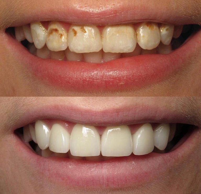 Veneers im All Inclusive Paket von DSG Schönheitsreisen Türkei