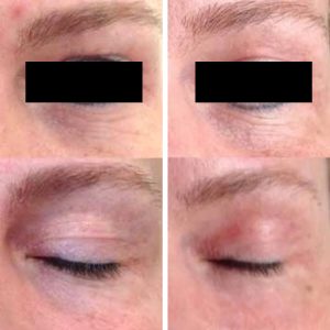 Vorher-Nachher-Bilder einer Augenlidstraffung. Links: hängende Oberlider, Falten um das Auge. Rechts: geglättetes Lid, Hautüberschuss entfernt. Eingriff in der Türkei.