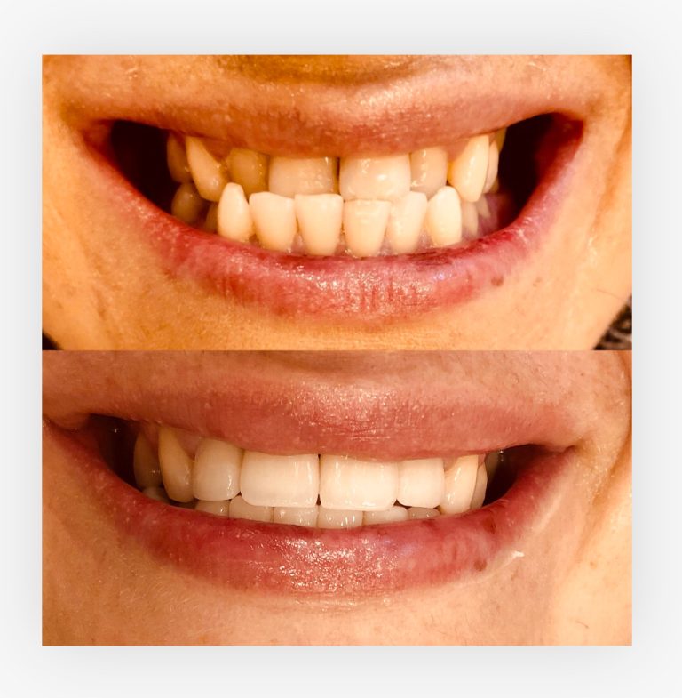 Zahnästhetik mit Veneers in der Türkei – sichtbare Veränderung durch Form- und Farbkorrektur.