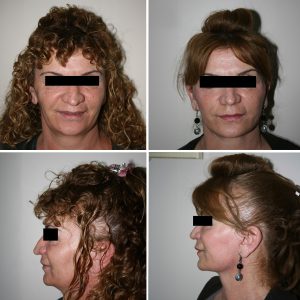 Vorher-Nachher-Bilder einer Frau nach Gesichtstraffung in der Türkei. Oben links und unten links: vor der OP mit erschlafften Gesichtszügen. Oben rechts und unten rechts: nach dem Eingriff, sichtbare Straffung an Wangen, Kinnlinie und Hals.