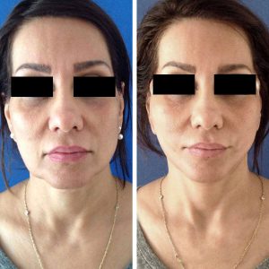 Vorher-Nachher-Bilder einer Frau nach Gesichtstraffung in der Türkei. Links: abgesackte Gesichtspartien, Hauterschlaffung. Rechts: gestraffte Konturen, geglättetes Hautbild.
