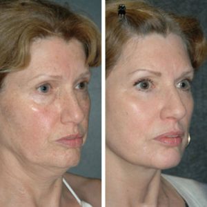 Seitlicher Vorher-Nachher-Vergleich einer Frau nach Gesichtstraffung. Links: sichtbare Hauterschlaffung an Wangen und Kinn. Rechts: gestraffte Gesichtskonturen, verjüngtes Hautbild.