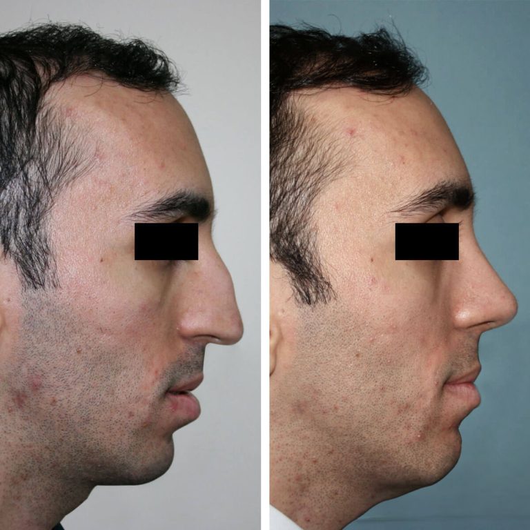 Vorher-Nachher-Bilder eines Mannes nach Nasen OP Türkei. Links: markanter Höcker, lange Nase mit abfallender Spitze. Rechts: gerader Rücken, verkürzte, definierte Nasenform.