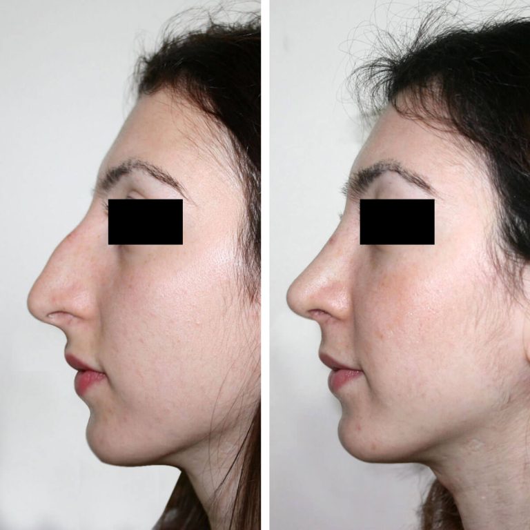 Vorher-Nachher-Bilder einer Nasenkorrektur in der Türkei. Links: Höcker auf dem Nasenrücken, hängende Nasenspitze. Rechts: geglätteter Nasenrücken, angehobene Spitze, harmonisches Profil.