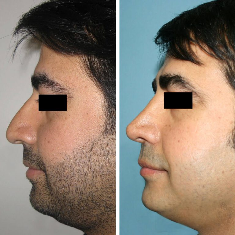 Seitliche Vorher-Nachher-Bilder eines Mannes nach Nasen OP in der Türkei. Links: großer Höcker, abfallende Spitze. Rechts: gerader Nasenrücken, verfeinerte Kontur.