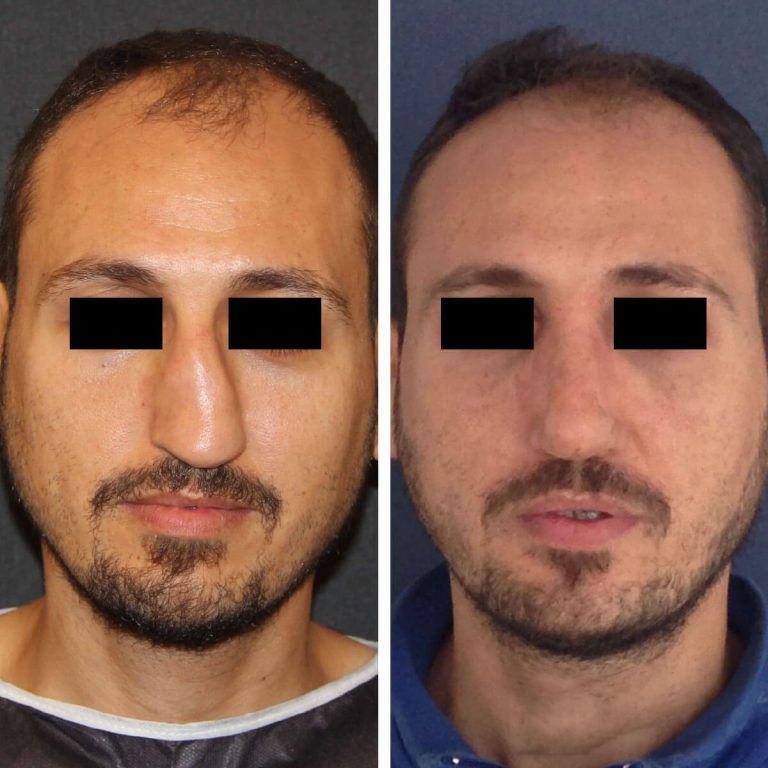 Frontalansicht eines Mannes vor und nach Nasenkorrektur in der Türkei. Links: deutlich schiefe Nase mit asymmetrischem Verlauf. Rechts: Nase begradigt, Symmetrie hergestellt.