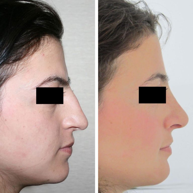 Vorher-Nachher-Bilder einer Nasenkorrektur in der Türkei. Links: starker Nasenhöcker, abfallende Nasenspitze. Rechts: glatter Nasenrücken, angehobene Spitze, ausgeglichenes Profil.