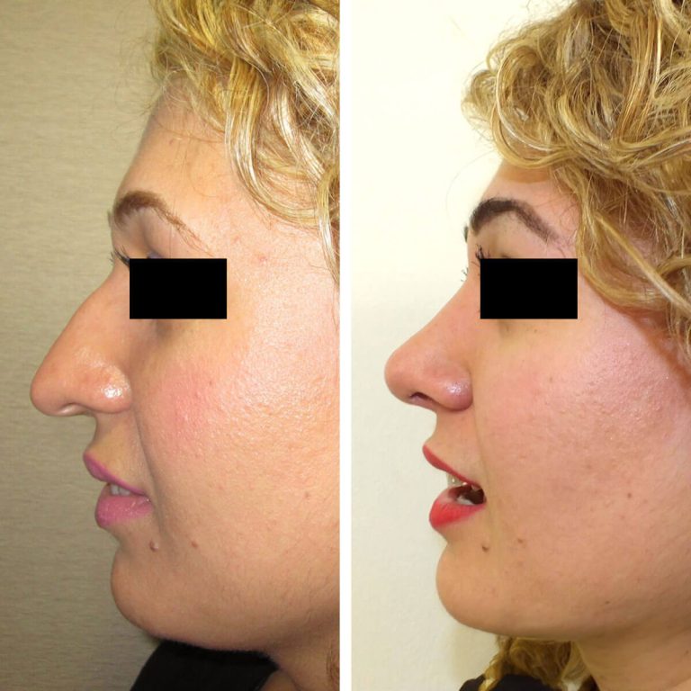 Vorher-Nachher-Bilder einer Nasenkorrektur in der Türkei. Links: ausgeprägter Nasenhöcker, abgesenkte Spitze. Rechts: gerader Nasenrücken, angehobene Spitze, symmetrisches Profil.