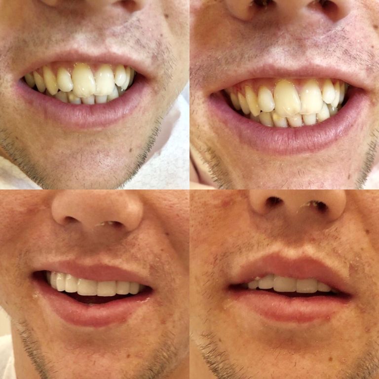 Vorher-Nachher-Vergleich eines Mannes vor und nach Veneers in der Türkei – oben schiefe, verfärbte Zähne, unten gerade und weiß.