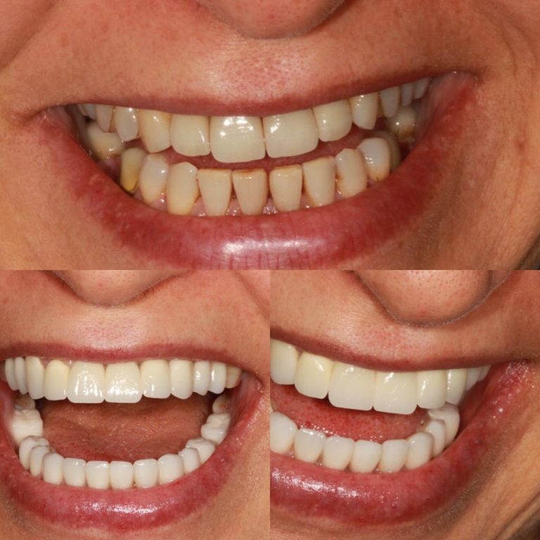 Vorher-Nachher-Vergleich eines Lächelns mit Zahnverblendungen (Veneers), oberes Bild zeigt verfärbte und unregelmäßige Zähne, untere Bilder präsentieren makellose, weiße Zahnreihen nach kosmetischer Zahnbehandlung.