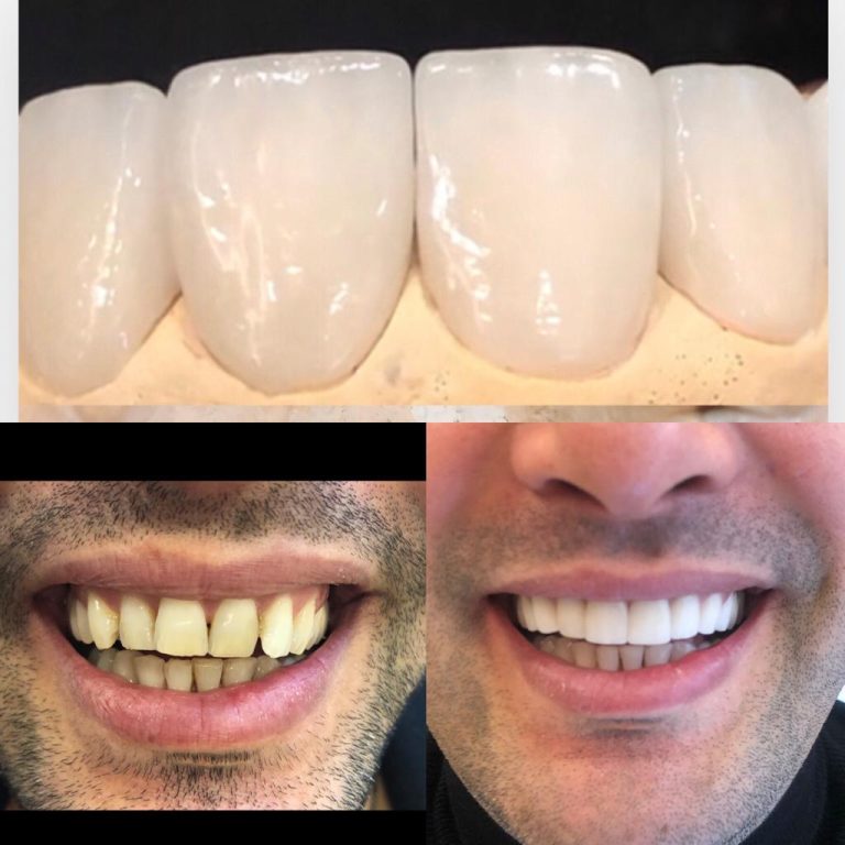 Hollywood Smile mit Vollkeramik-Veneers für obere Frontzähne – ästhetische Zahnbehandlung in der Türkei.