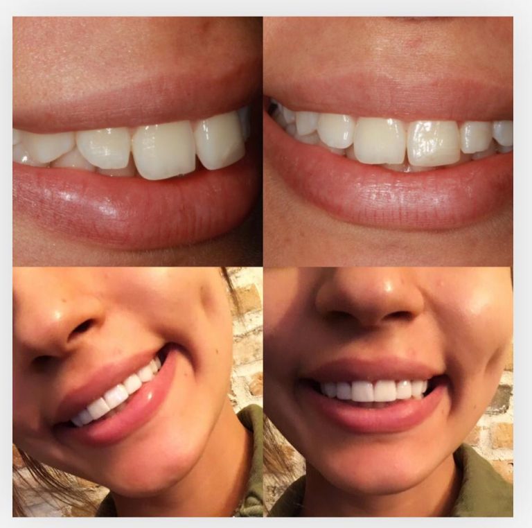 Ästhetische Zahnverschönerung mit Veneers in der Türkei – Vorher-nachher-Ergebnis einer kosmetischen Zahnbehandlung.