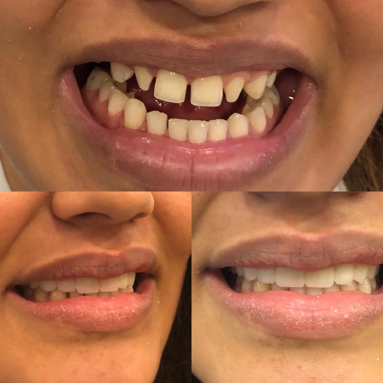 Ästhetische Zahnkorrektur mit Veneers und Kronen bei schiefen Zähnen – professionell durchgeführt in der Türkei.