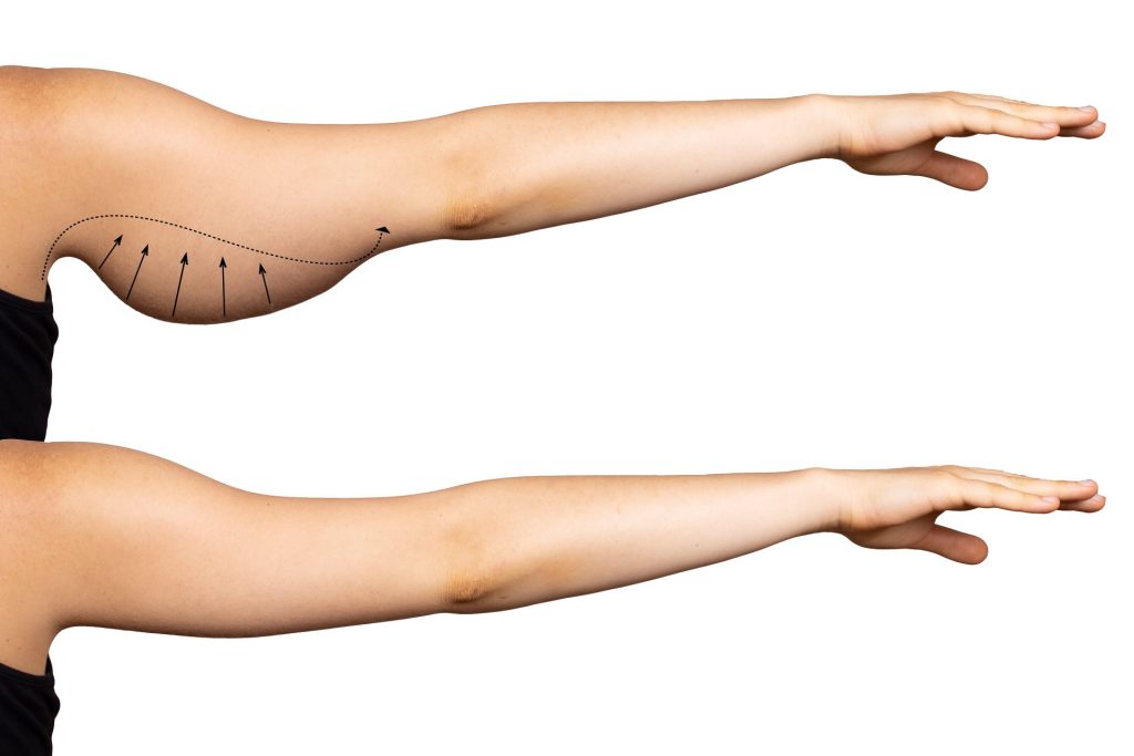 Zwei weibliche Oberarme im Seitenvergleich, oberer Arm mit markierter Fettabsaugungszone, unterer Arm nach dem Eingriff gestrafft.