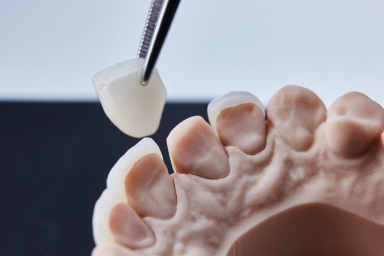 Zahnveneers werden präzise auf ein Zahnmodell angepasst.