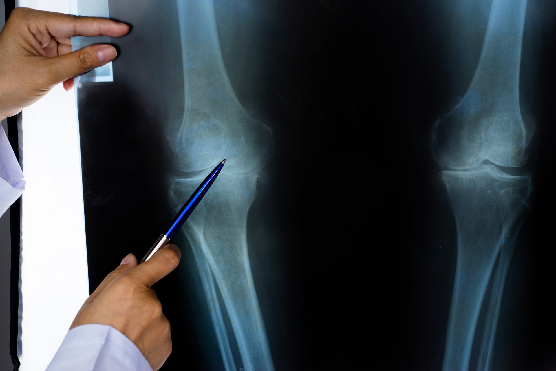 stammzelltherapie_röntgen_arthrose